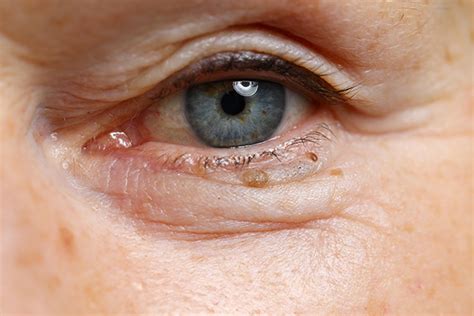 moles under eyes.